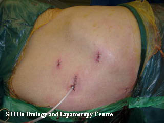 Laparoscopy surgery for prostate kidney adrenal varicocele